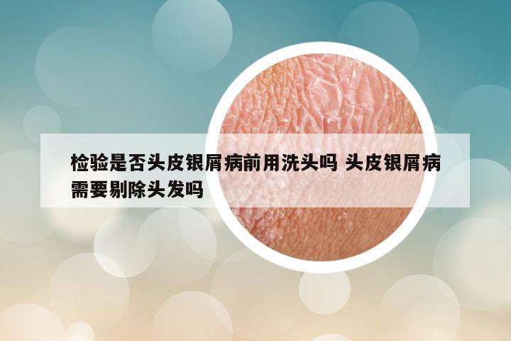 检验是否头皮银屑病前用洗头吗 头皮银屑病需要剔除头发吗