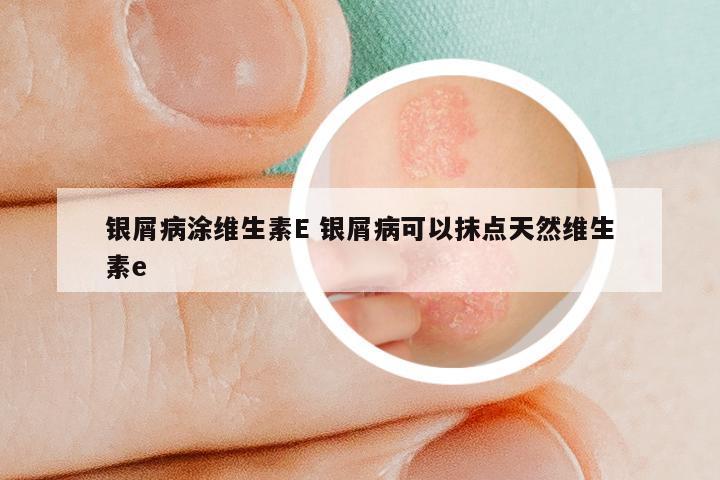 银屑病涂维生素E 银屑病可以抹点天然维生素e