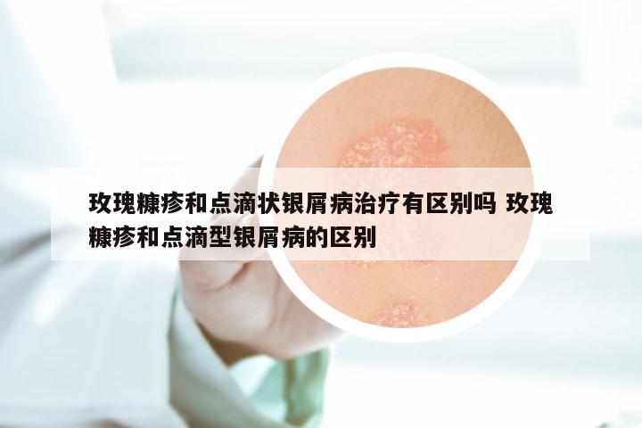 玫瑰糠疹和点滴状银屑病治疗有区别吗 玫瑰糠疹和点滴型银屑病的区别