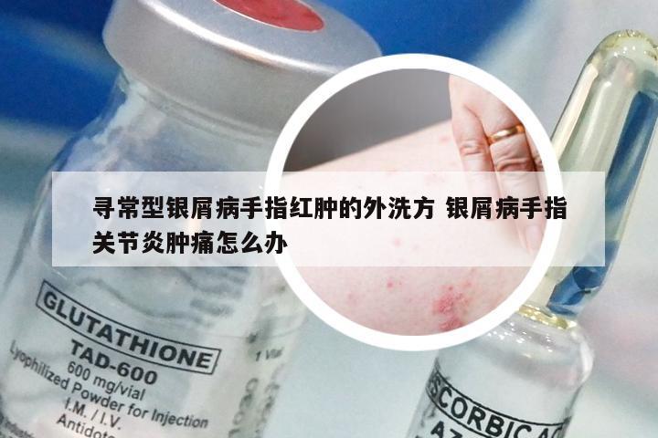 寻常型银屑病手指红肿的外洗方 银屑病手指关节炎肿痛怎么办