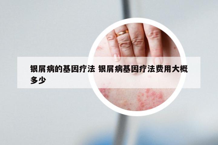 银屑病的基因疗法 银屑病基因疗法费用大概多少