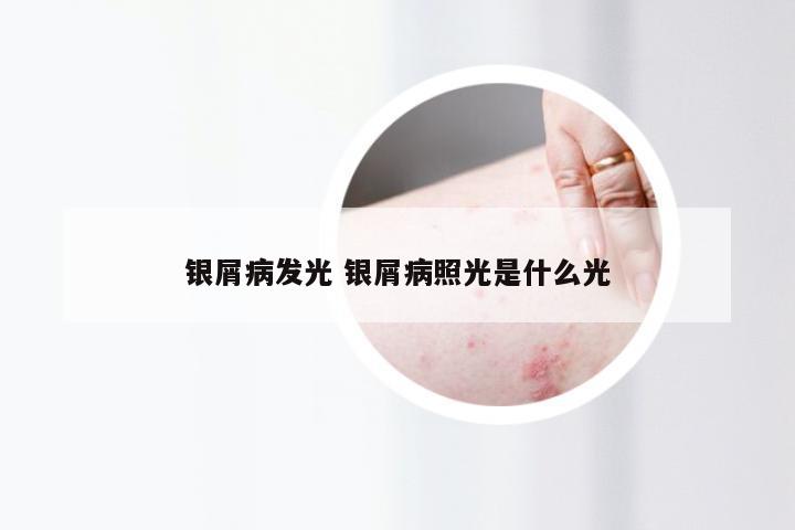 银屑病发光 银屑病照光是什么光