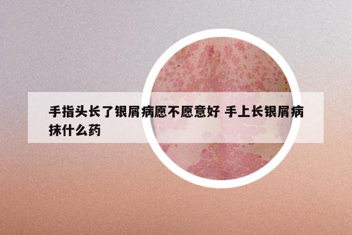 手指头长了银屑病愿不愿意好 手上长银屑病抹什么药