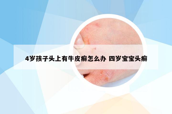 4岁孩子头上有牛皮癣怎么办 四岁宝宝头癣