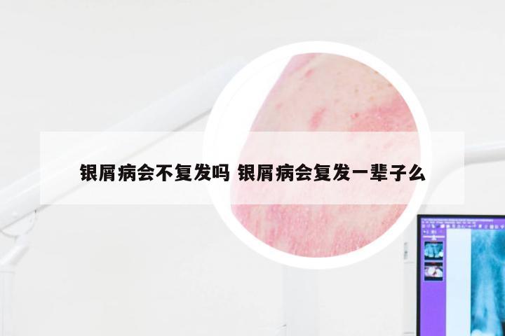 银屑病会不复发吗 银屑病会复发一辈子么