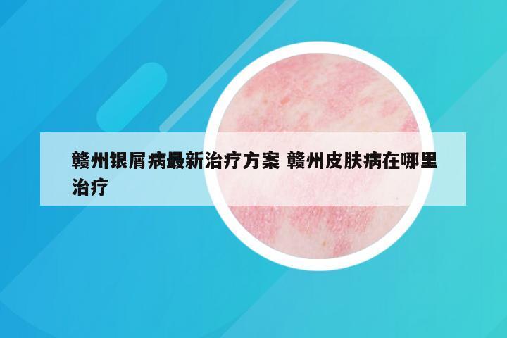 赣州银屑病最新治疗方案 赣州皮肤病在哪里治疗