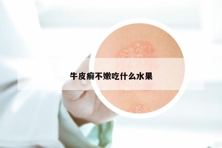 牛皮癣不嫩吃什么水果