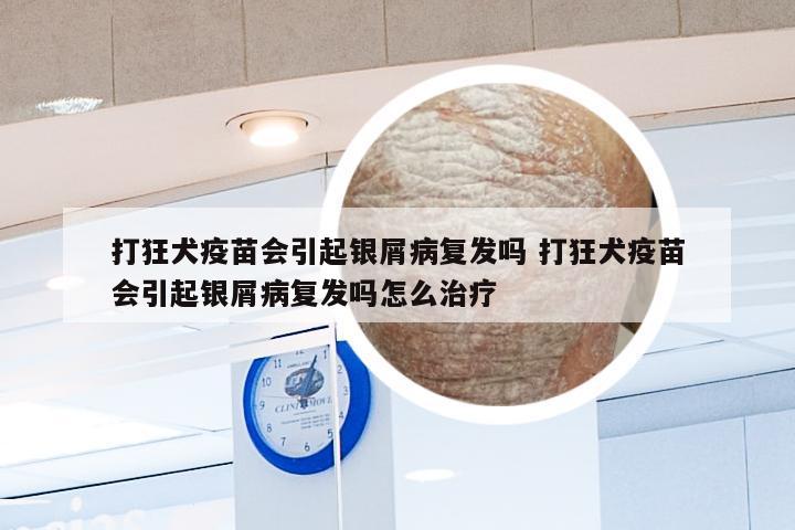 打狂犬疫苗会引起银屑病复发吗 打狂犬疫苗会引起银屑病复发吗怎么治疗