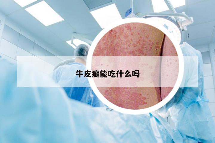 牛皮癣能吃什么吗
