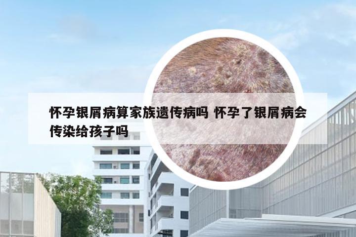 怀孕银屑病算家族遗传病吗 怀孕了银屑病会传染给孩子吗