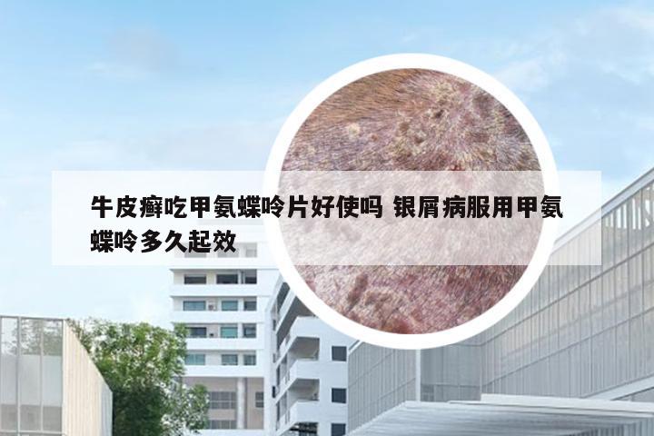 牛皮癣吃甲氨蝶呤片好使吗 银屑病服用甲氨蝶呤多久起效