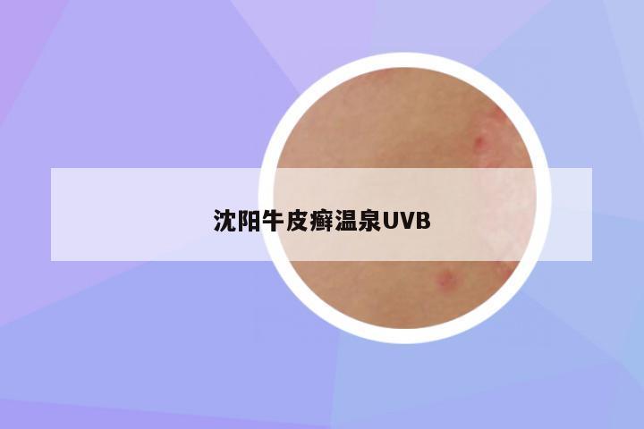 沈阳牛皮癣温泉UVB