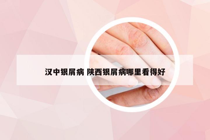汉中银屑病 陕西银屑病哪里看得好