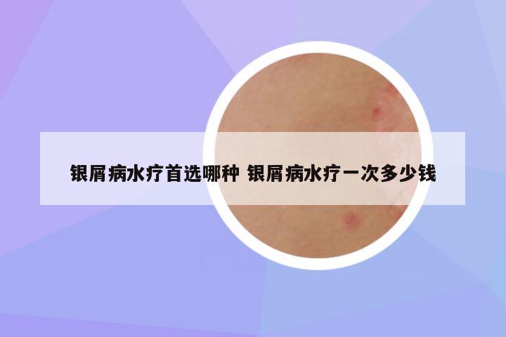 银屑病水疗首选哪种 银屑病水疗一次多少钱