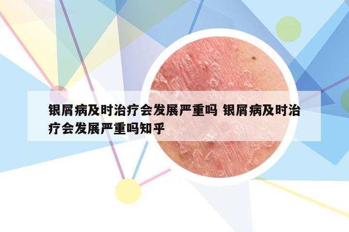 银屑病及时治疗会发展严重吗 银屑病及时治疗会发展严重吗知乎