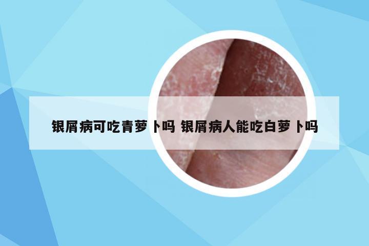 银屑病可吃青萝卜吗 银屑病人能吃白萝卜吗