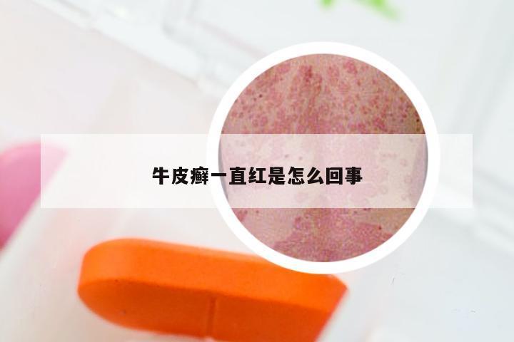 牛皮癣一直红是怎么回事