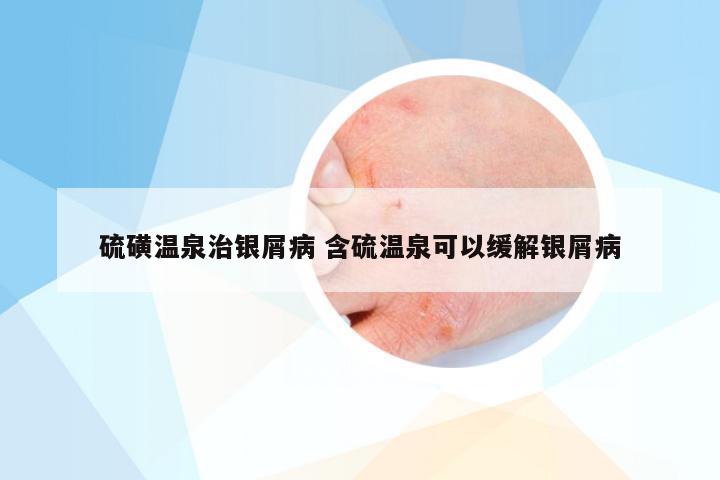 硫磺温泉治银屑病 含硫温泉可以缓解银屑病