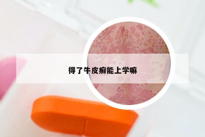 得了牛皮癣能上学嘛