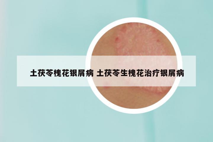 土茯苓槐花银屑病 土茯苓生槐花治疗银屑病