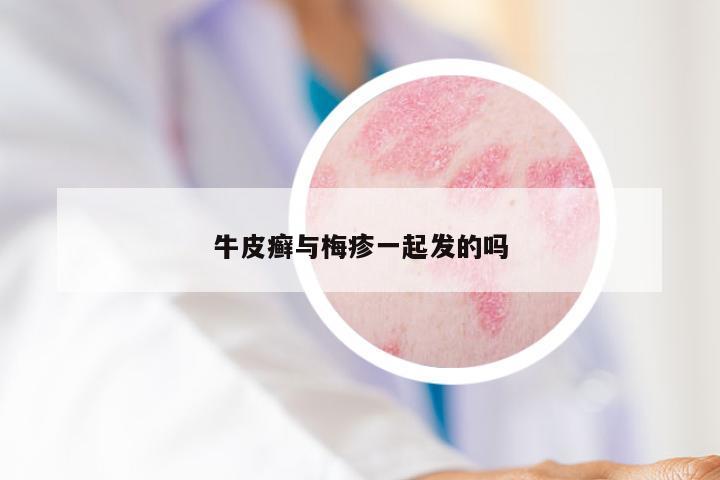 牛皮癣与梅疹一起发的吗