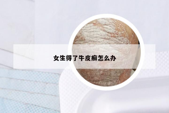 女生得了牛皮癣怎么办