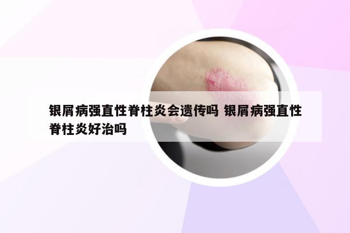 银屑病强直性脊柱炎会遗传吗 银屑病强直性脊柱炎好治吗