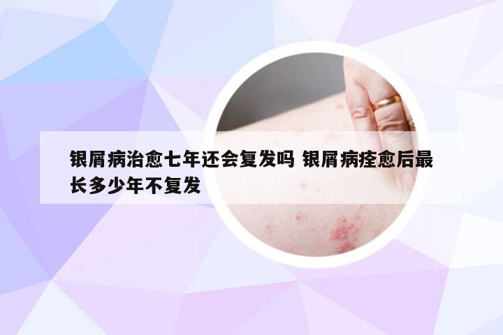 银屑病治愈七年还会复发吗 银屑病痊愈后最长多少年不复发