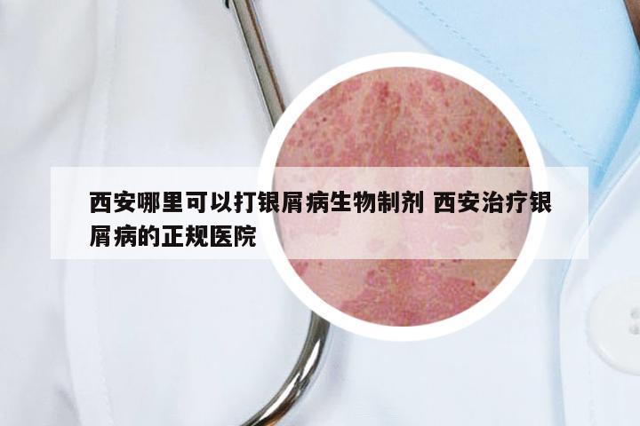西安哪里可以打银屑病生物制剂 西安治疗银屑病的正规医院