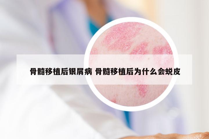 骨髓移植后银屑病 骨髓移植后为什么会蜕皮