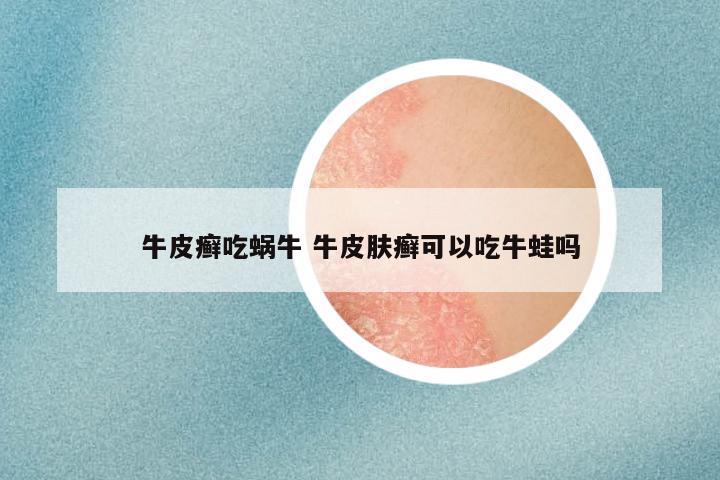 牛皮癣吃蜗牛 牛皮肤癣可以吃牛蛙吗