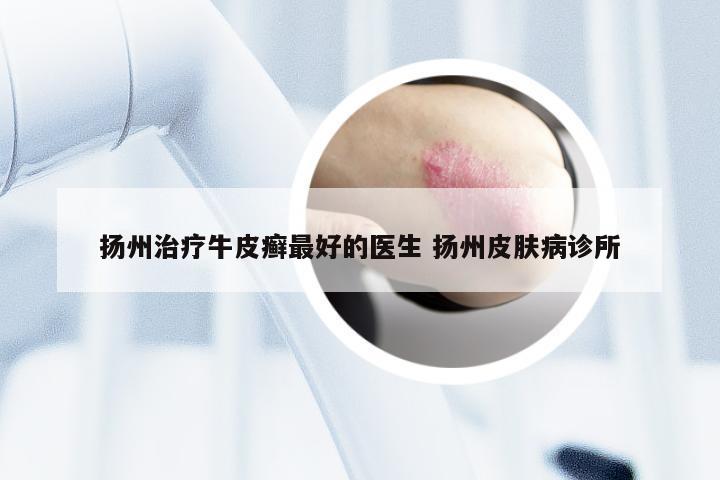 扬州治疗牛皮癣最好的医生 扬州皮肤病诊所