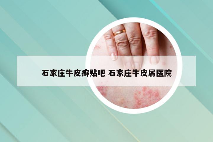 石家庄牛皮癣贴吧 石家庄牛皮屑医院