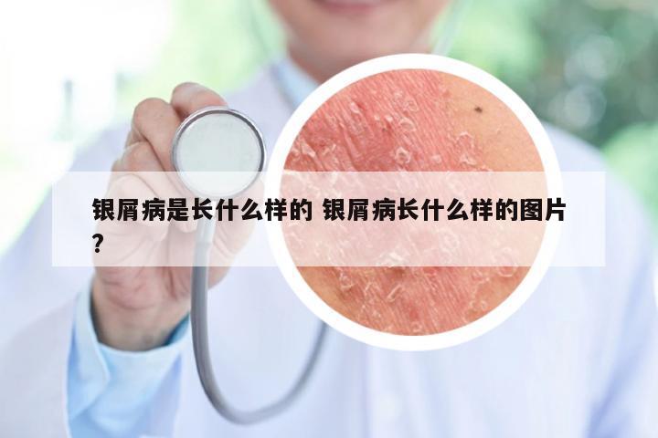 银屑病是长什么样的 银屑病长什么样的图片?
