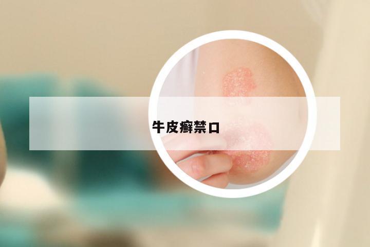 牛皮癣禁口
