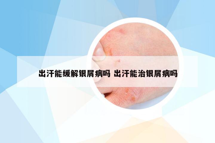 出汗能缓解银屑病吗 出汗能治银屑病吗