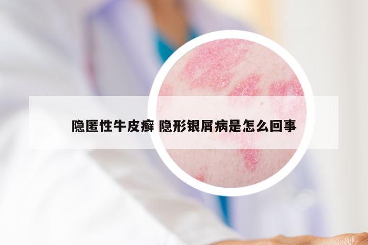 隐匿性牛皮癣 隐形银屑病是怎么回事