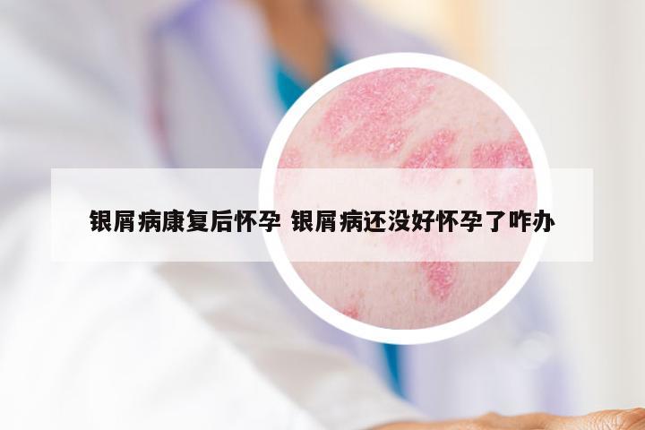 银屑病康复后怀孕 银屑病还没好怀孕了咋办