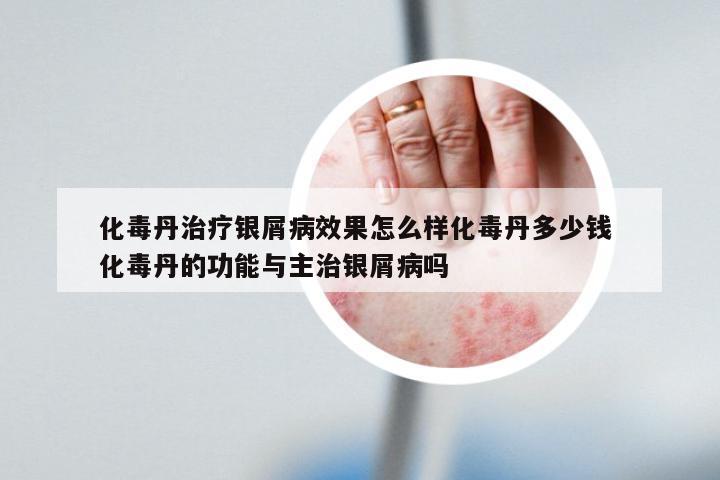 化毒丹治疗银屑病效果怎么样化毒丹多少钱 化毒丹的功能与主治银屑病吗