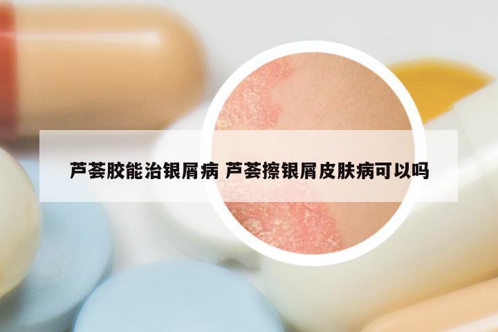 芦荟胶能治银屑病 芦荟擦银屑皮肤病可以吗