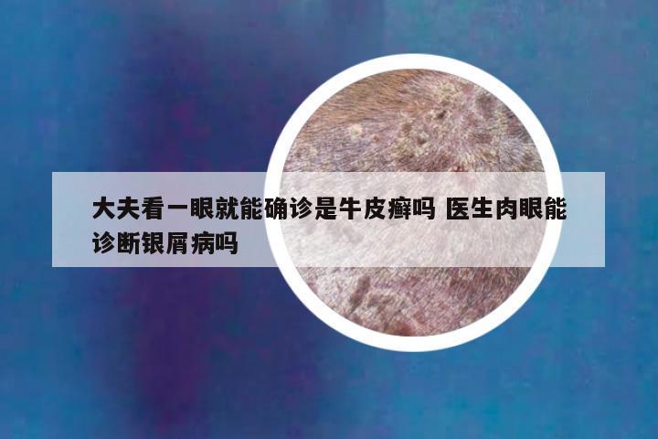 大夫看一眼就能确诊是牛皮癣吗 医生肉眼能诊断银屑病吗