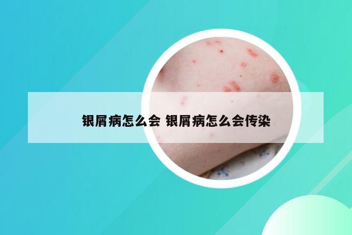 银屑病怎么会 银屑病怎么会传染