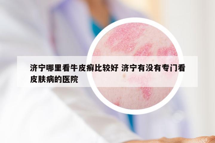 济宁哪里看牛皮癣比较好 济宁有没有专门看皮肤病的医院