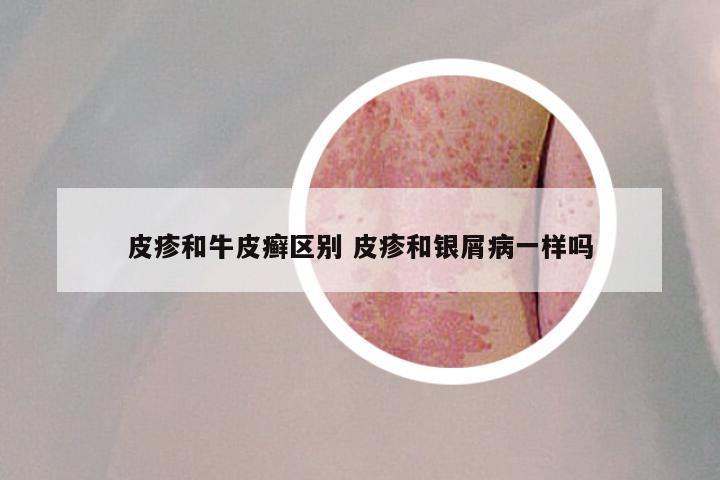 皮疹和牛皮癣区别 皮疹和银屑病一样吗