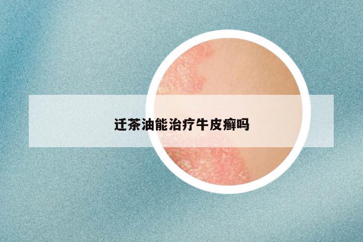 迁茶油能治疗牛皮癣吗