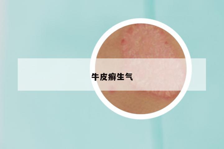 牛皮癣生气