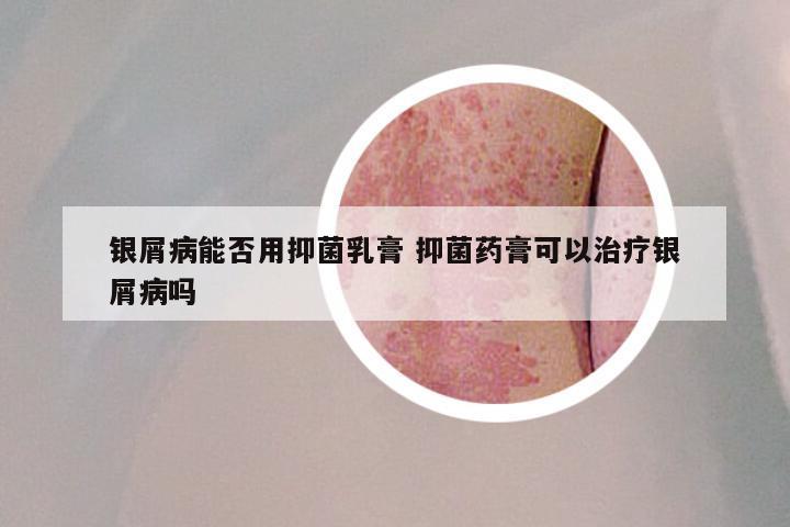 银屑病能否用抑菌乳膏 抑菌药膏可以治疗银屑病吗