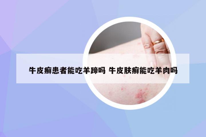 牛皮癣患者能吃羊蹄吗 牛皮肤癣能吃羊肉吗
