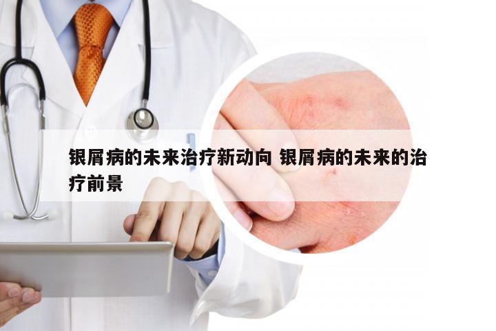 银屑病的未来治疗新动向 银屑病的未来的治疗前景