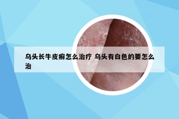 乌头长牛皮癣怎么治疗 乌头有白色的要怎么治